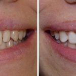 3 Popular Inexpensive Cosmetic Dental Procedures