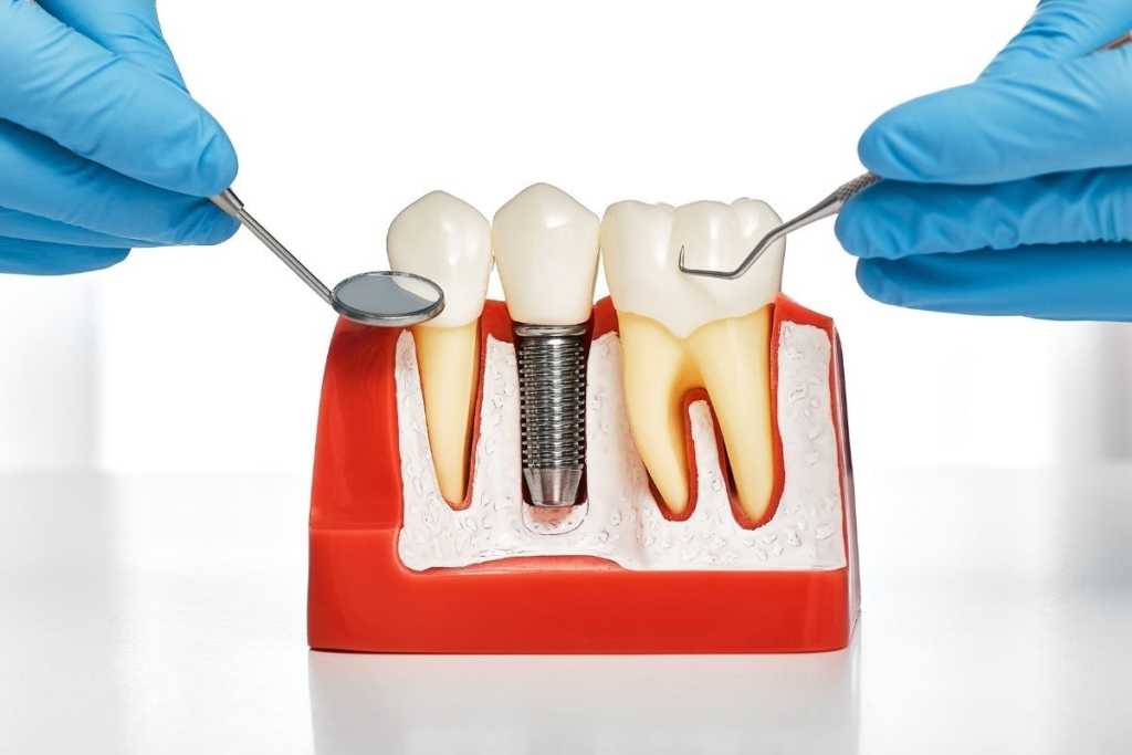 dental implant surgery in Agoura Hills