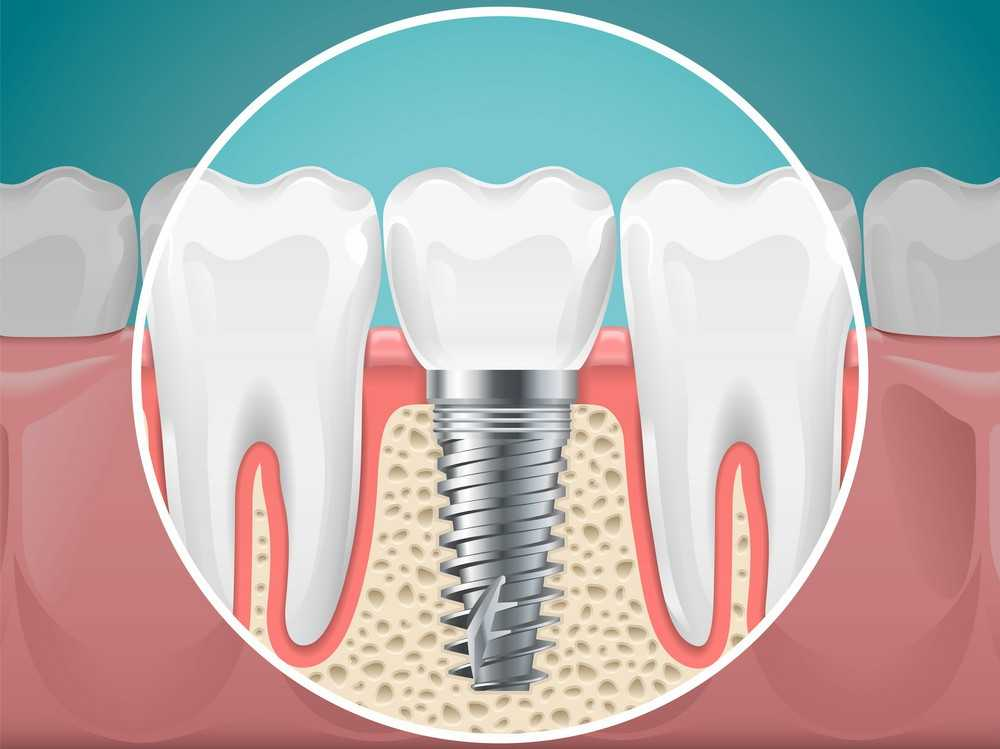 The Ultimate Guide to Dental Implants: Restore Your Smile Forever